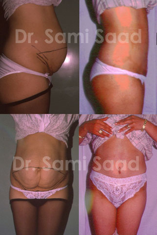 Bodylift (Belt Dermolipectomy)