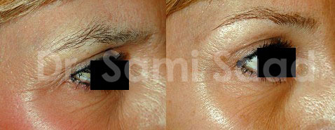 Eyelid Surgery