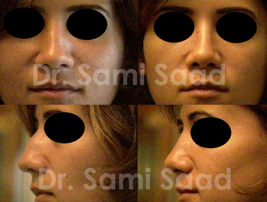 Nose Surgery