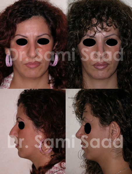 Nose Surgery