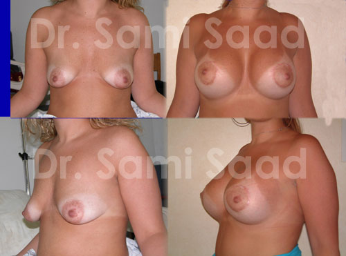 Breast Augmentation