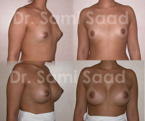 Breast Augmentation