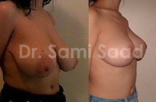 Breast Lift