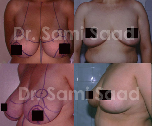 Breast Reduction