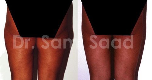 Liposuction