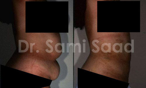 Liposuction