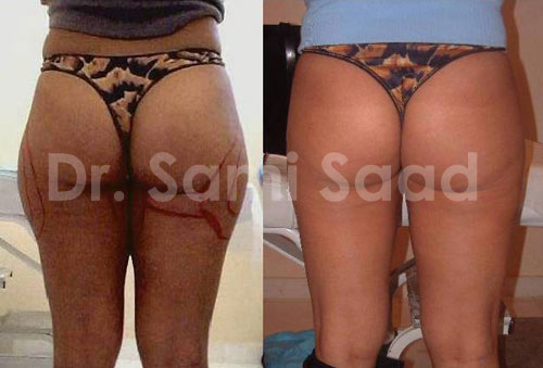 Liposuction