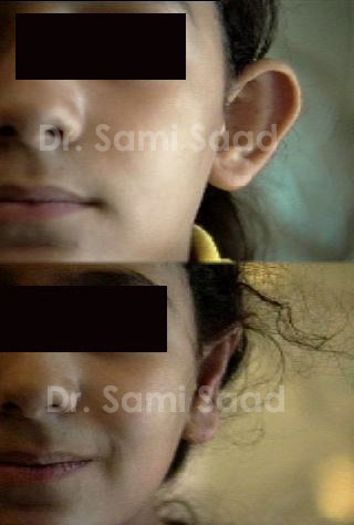 Ear Surgery
